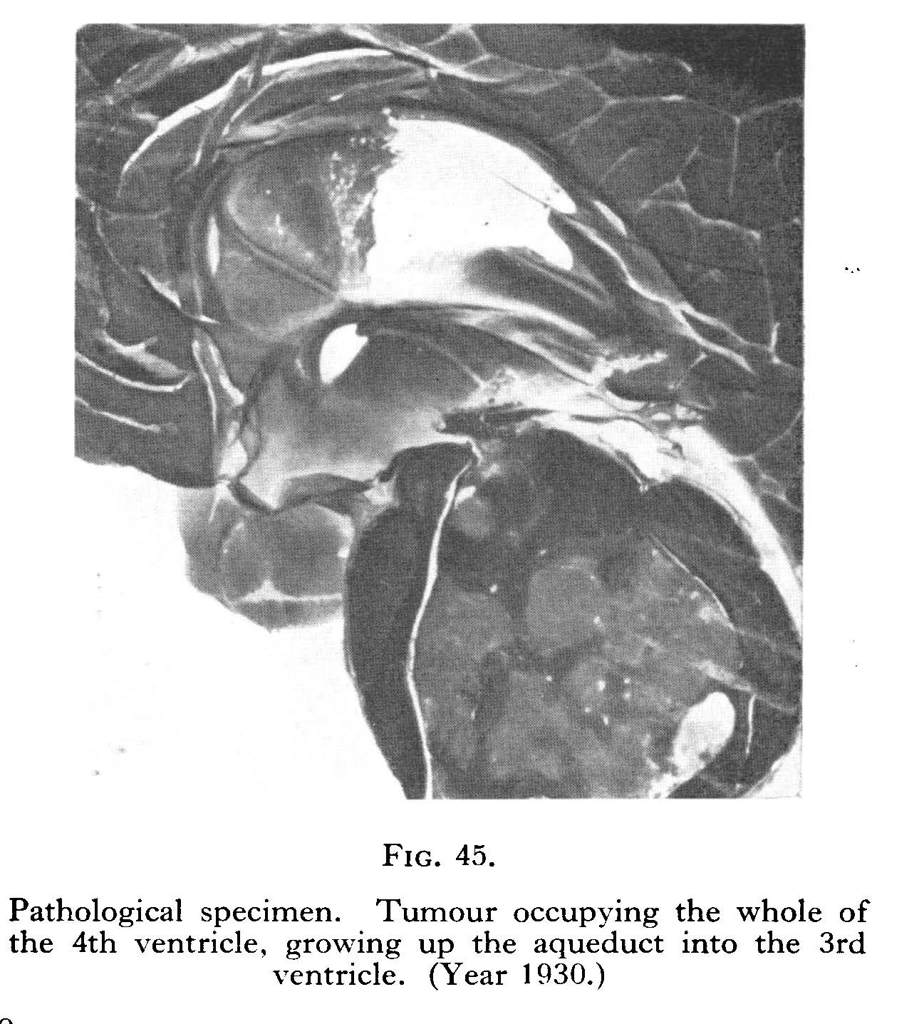 Tumour occupying the whole of the left ventricle