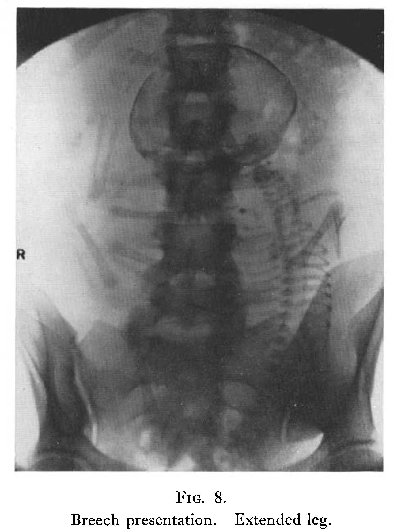 X-ray of baby in breech position