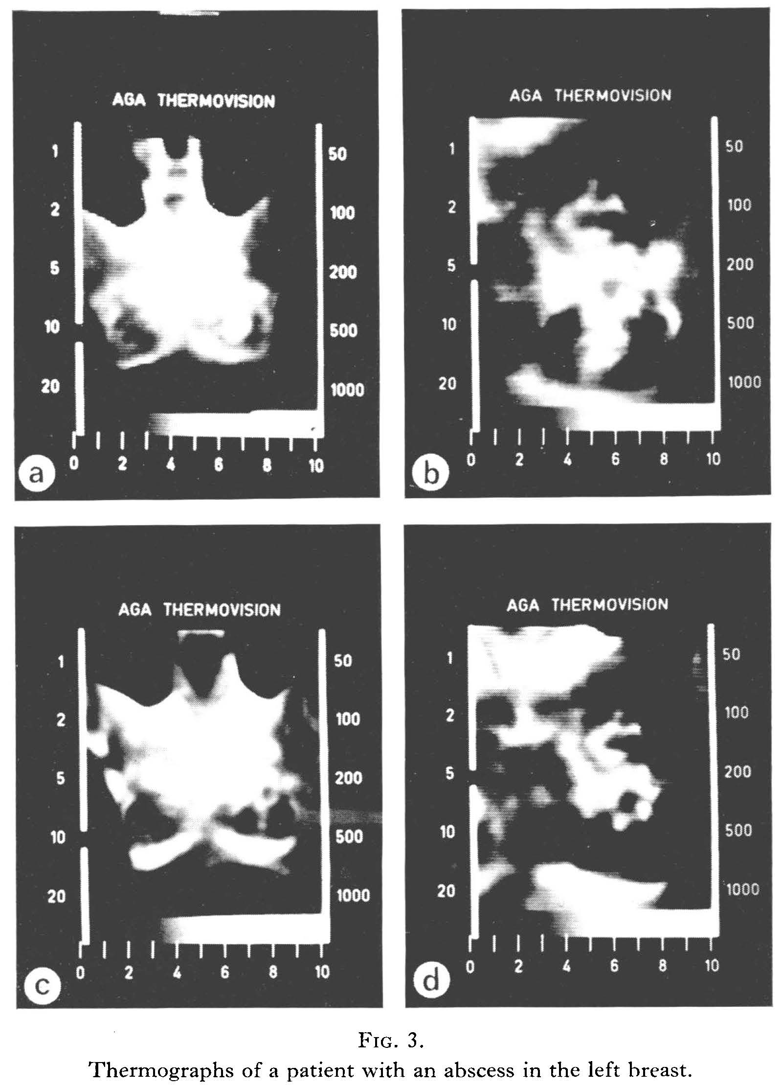 Breast thermograph