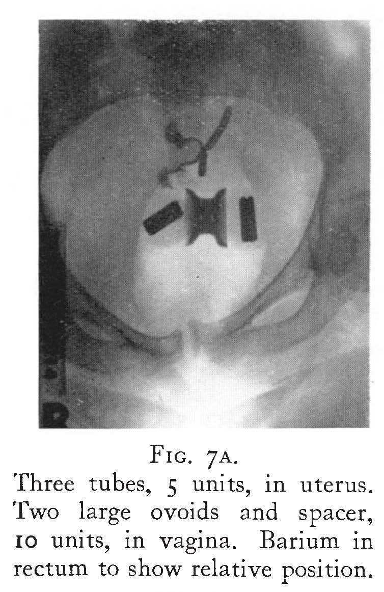 Treatment of cancer of cervix