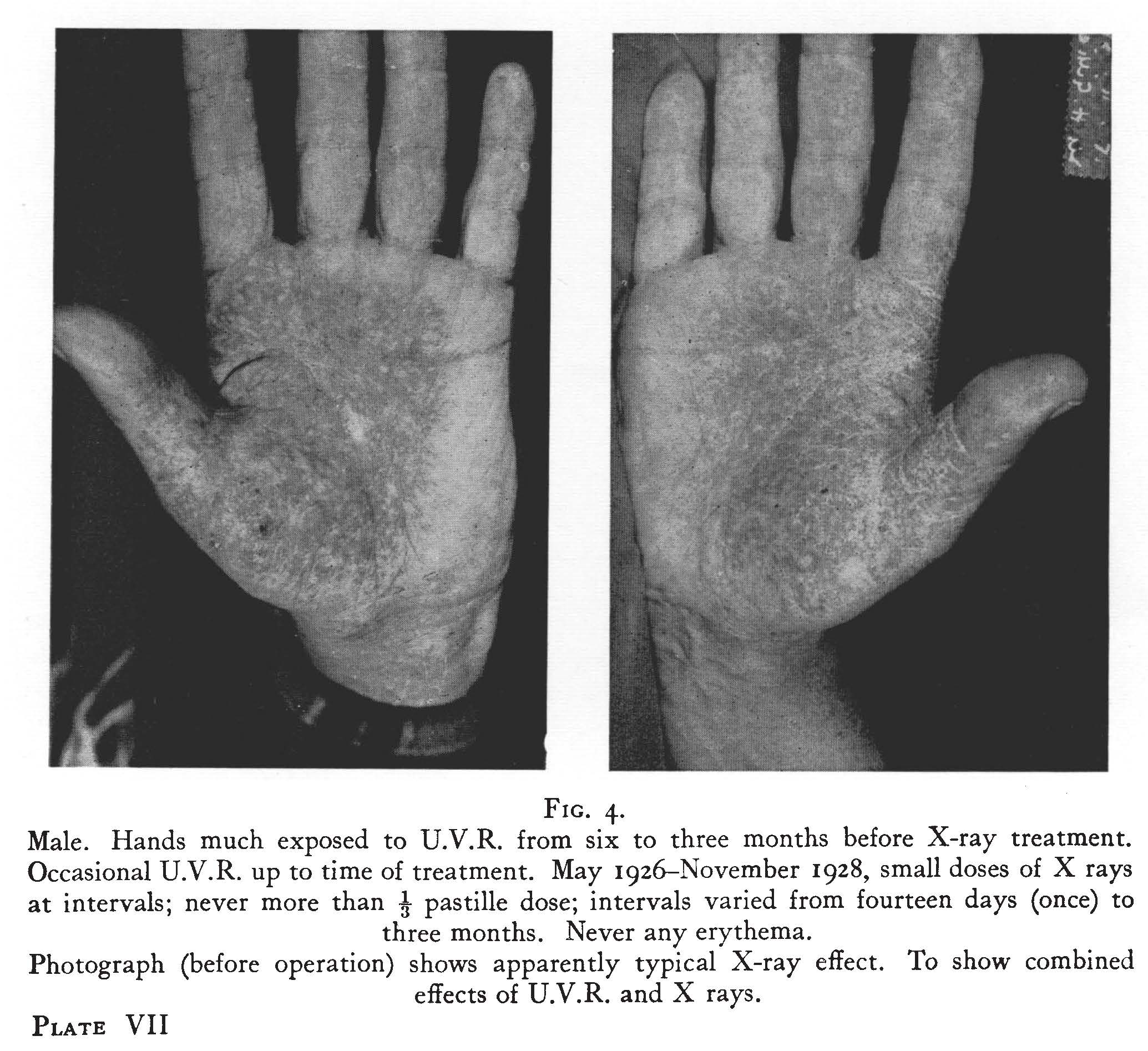 Hand exposure to UVR