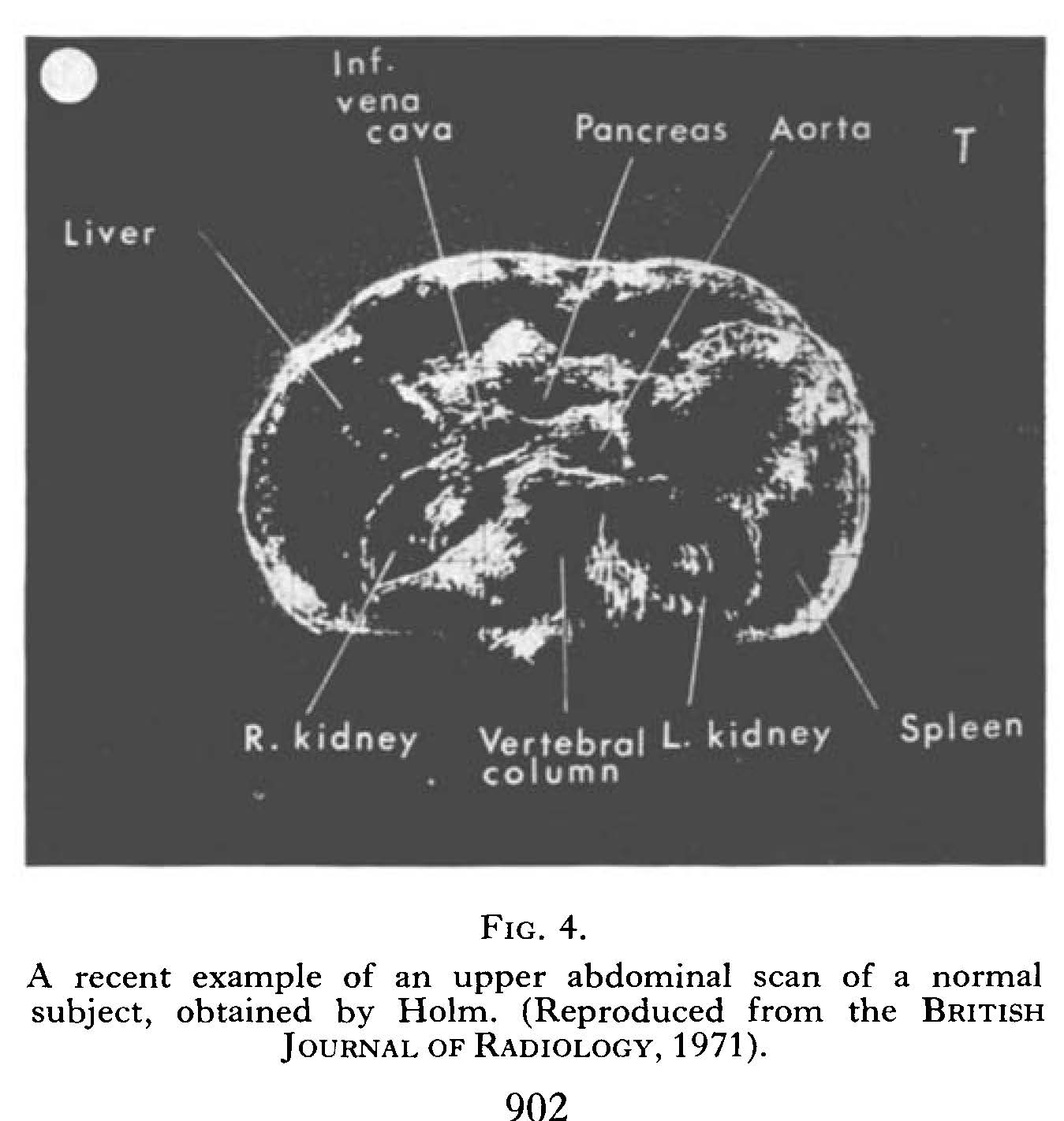 Upper abdominal scan of the normal subject