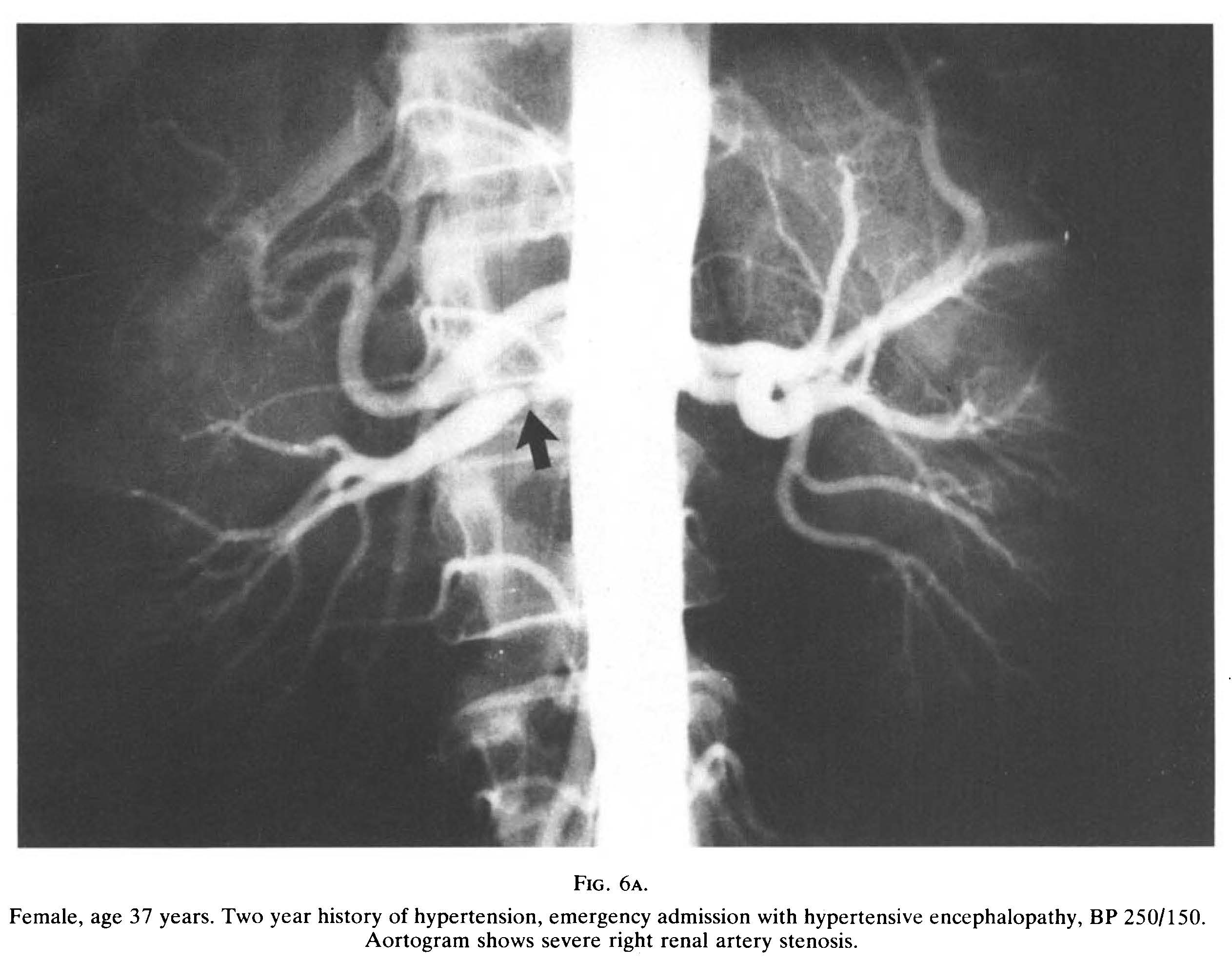 Image of renal artery stenosis