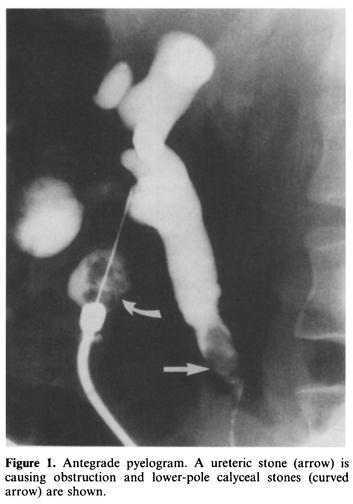 Stone in ureter