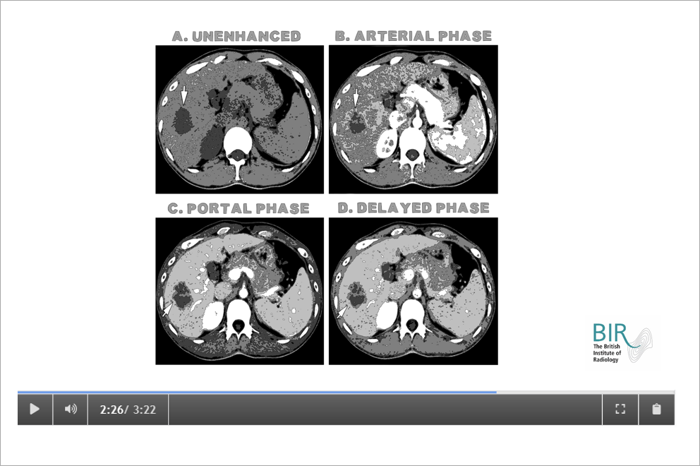 CT scan images CT scan images
